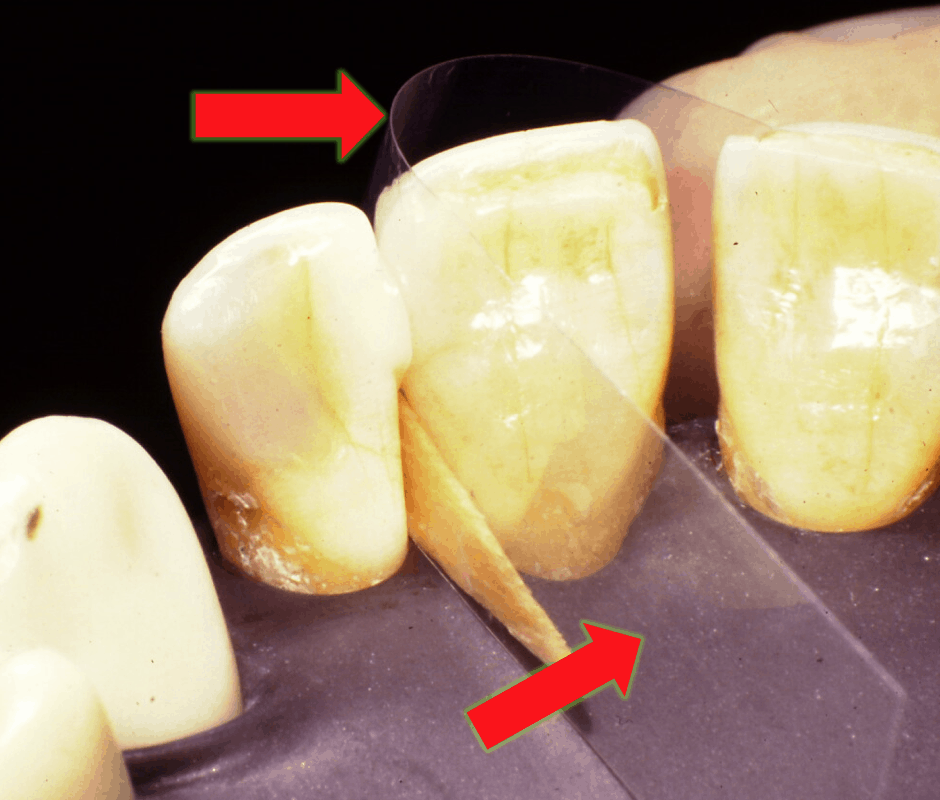 Mylar Strip Set Stevenson Dental Solutions