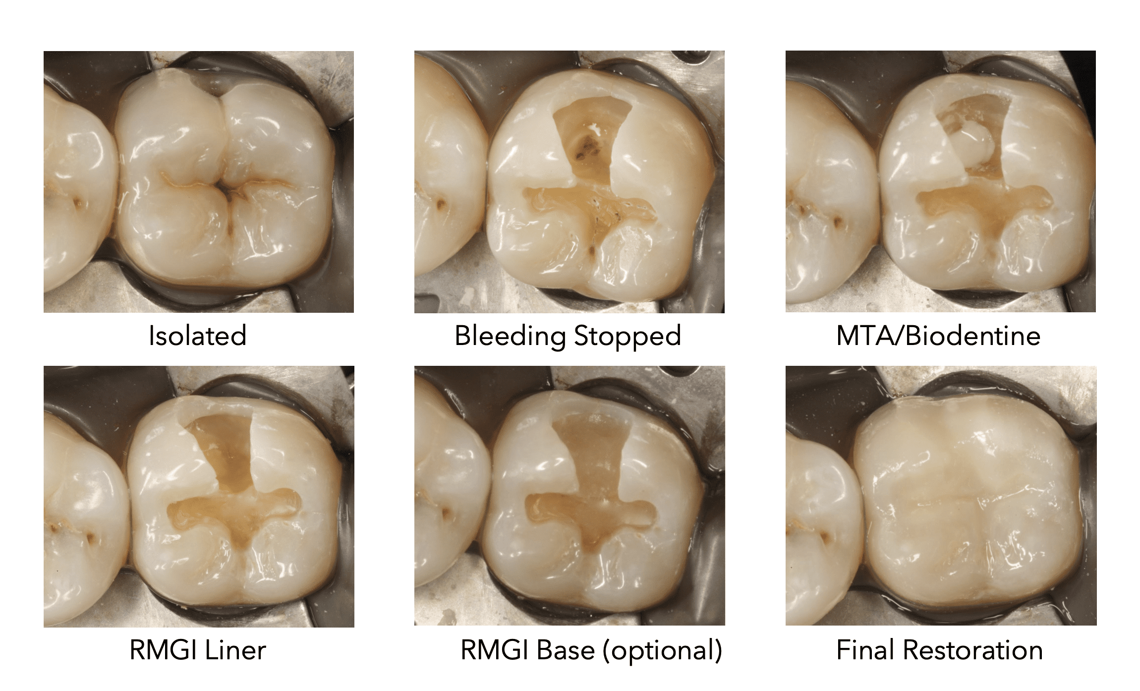 PDF Success Of Direct Pulp Capping And Partial Pulpotomy 54 OFF