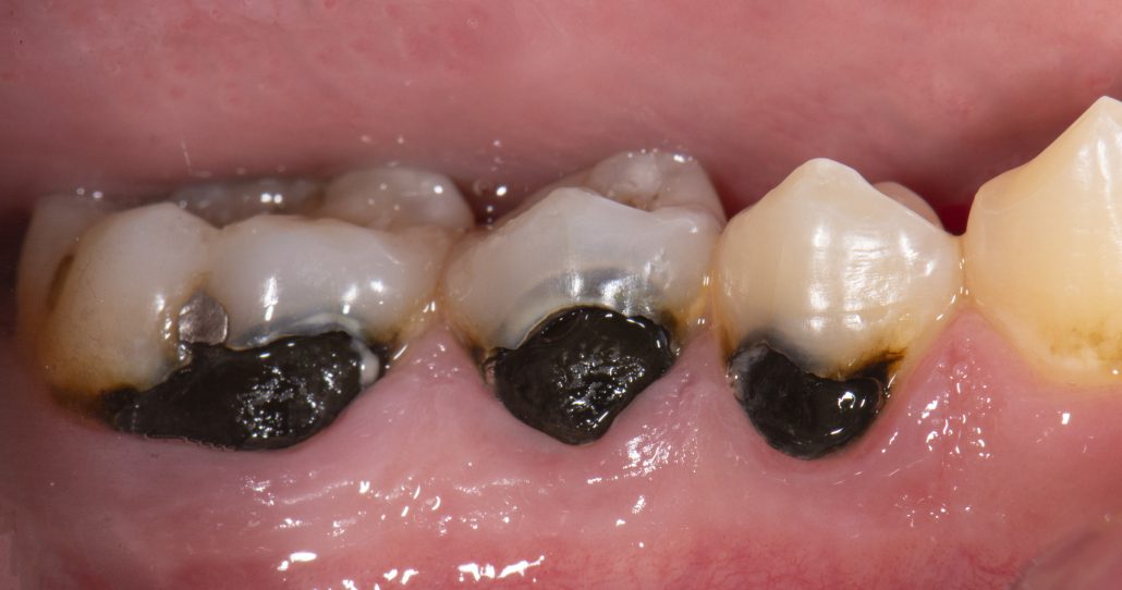 How to benefit from silver diamine fluoride for adult patients