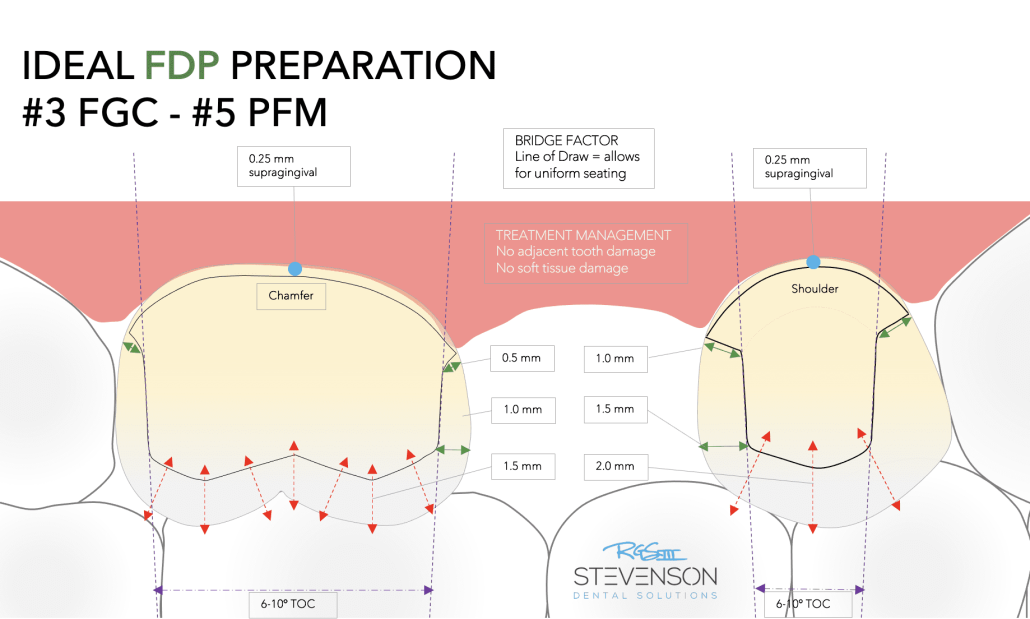 Illustrated diagram showing ideal fixed dental prosthesis preparation criteria used in ADEX exam preparation